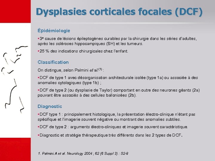 Dysplasies corticales focales (DCF) Épidémiologie § 3 e cause de lésions épileptogènes curables par