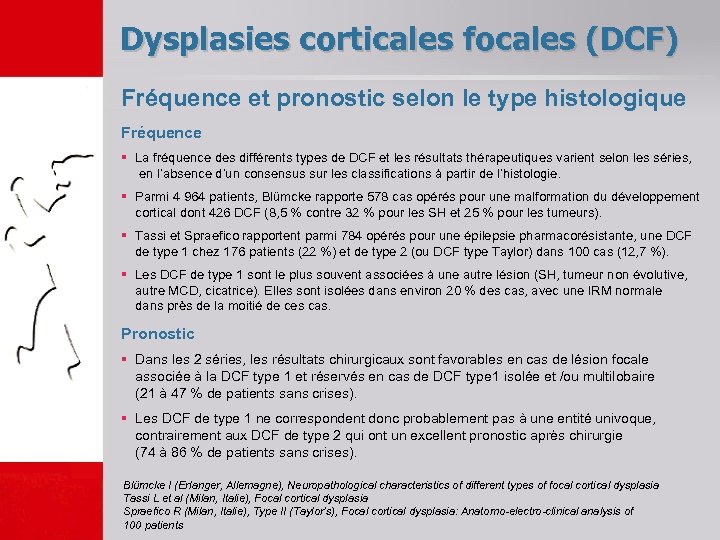 Dysplasies corticales focales (DCF) Fréquence et pronostic selon le type histologique Fréquence § La