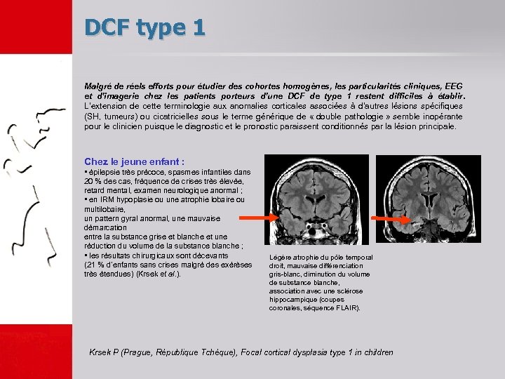 DCF type 1 Malgré de réels efforts pour étudier des cohortes homogènes, les particularités