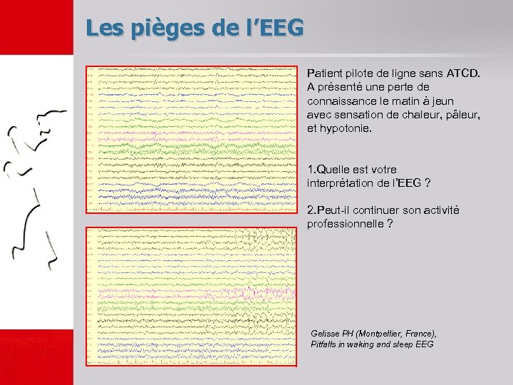 Les pièges de l’EEG Patient pilote de ligne sans ATCD. A présenté une perte