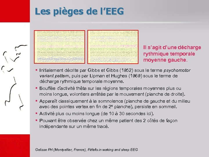 Les pièges de l’EEG Il s’agit d’une décharge rythmique temporale moyenne gauche. § Initialement