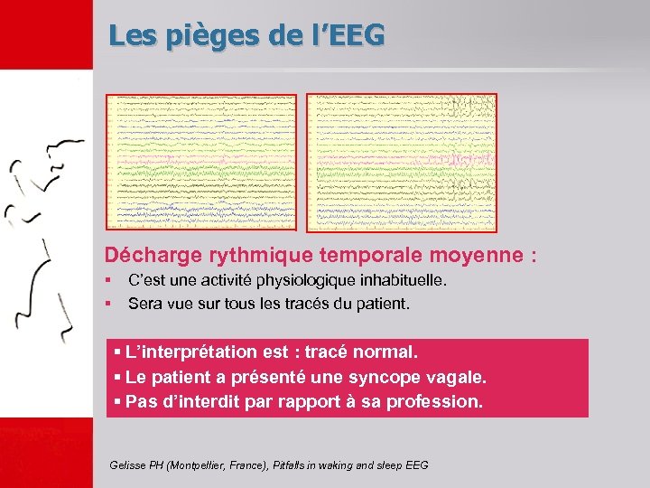 Les pièges de l’EEG Décharge rythmique temporale moyenne : § C’est une activité physiologique