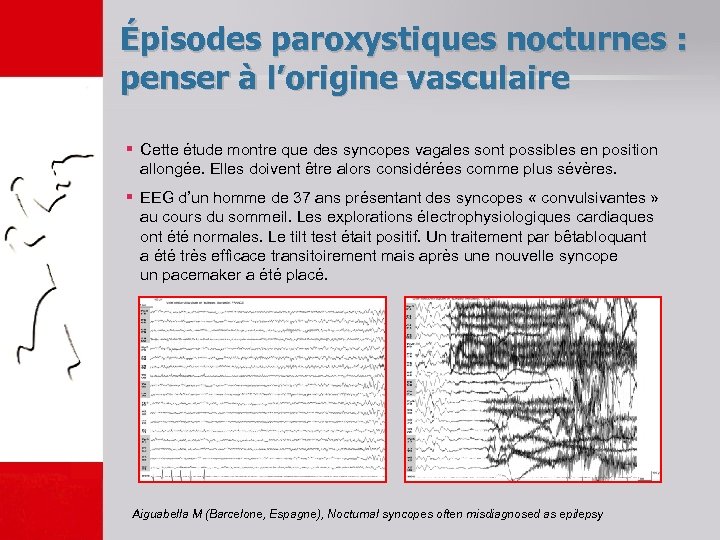 Épisodes paroxystiques nocturnes : penser à l’origine vasculaire § Cette étude montre que des
