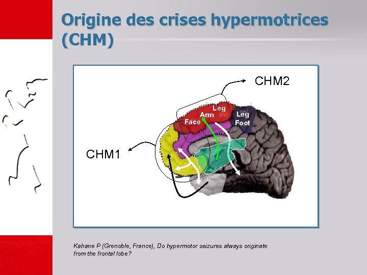 Origine des crises hypermotrices (CHM) CHM 2 Leg Arm Face Leg Foot CHM 1