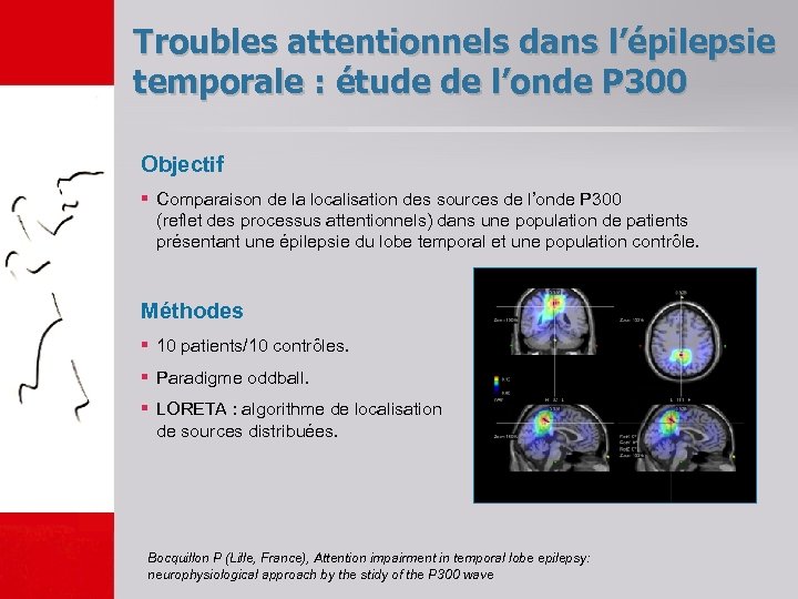 Troubles attentionnels dans l’épilepsie temporale : étude de l’onde P 300 Objectif § Comparaison