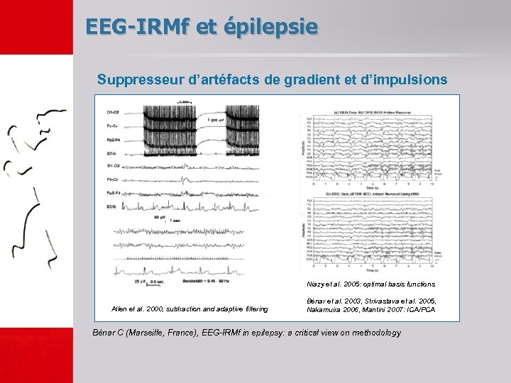 EEG-IRMf et épilepsie Suppresseur d’artéfacts de gradient et d’impulsions Niazy et al. 2005: optimal