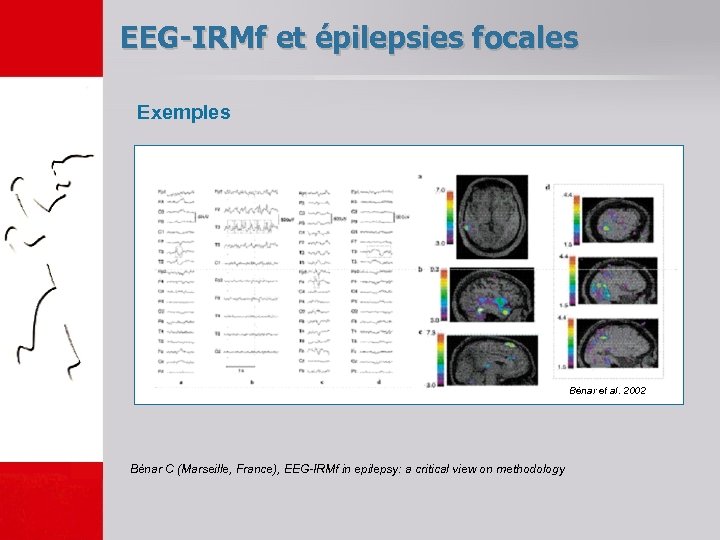 EEG-IRMf et épilepsies focales Exemples Bénar et al. 2002 Bénar C (Marseille, France), EEG-IRMf
