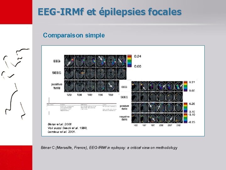 EEG-IRMf et épilepsies focales Comparaison simple Bénar et al. 2006 Voir aussi Seeck et