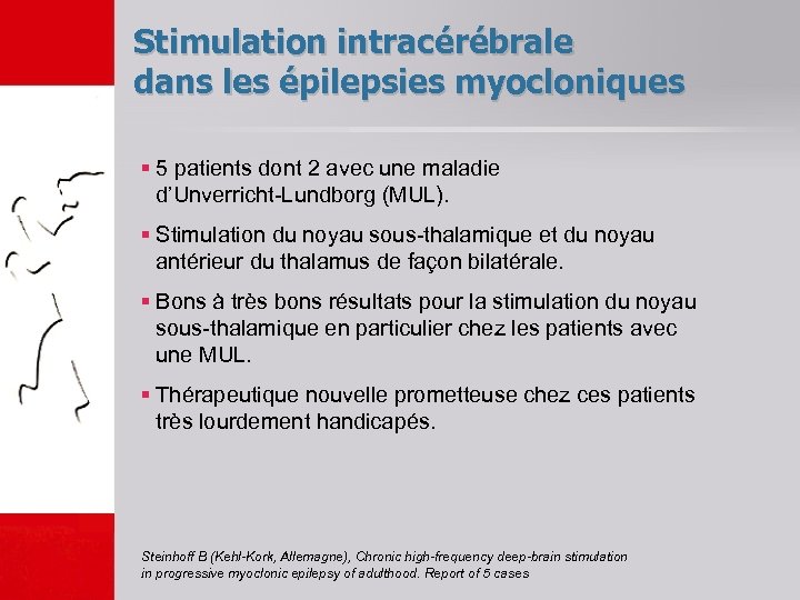 Stimulation intracérébrale dans les épilepsies myocloniques § 5 patients dont 2 avec une maladie