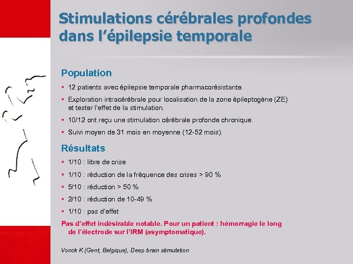 Stimulations cérébrales profondes dans l’épilepsie temporale Population § 12 patients avec épilepsie temporale pharmacorésistante.