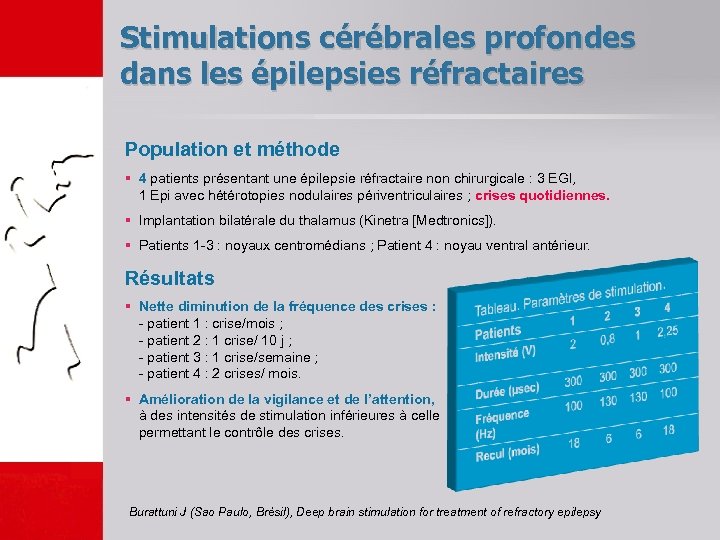 Stimulations cérébrales profondes dans les épilepsies réfractaires Population et méthode § 4 patients présentant