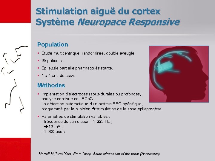 Stimulation aiguë du cortex Système Neuropace Responsive Population § Étude multicentrique, randomisée, double aveugle.