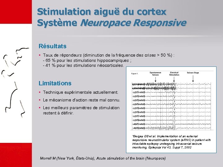 Stimulation aiguë du cortex Système Neuropace Responsive Résultats § Taux de répondeurs (diminution de