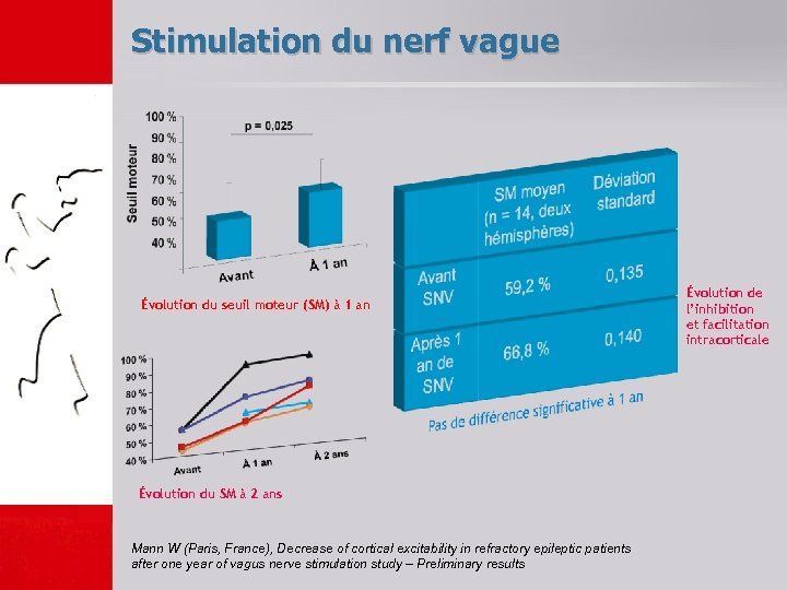 Stimulation du nerf vague Évolution du seuil moteur (SM) à 1 an Évolution du