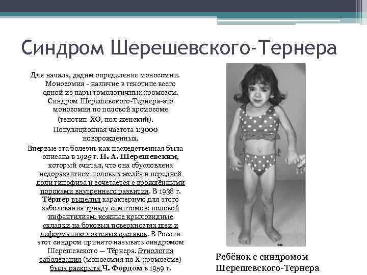 Синдром Шерешевского-Тернера Для начала, дадим определение моносомии. Моносомия - наличие в генотипе всего одной