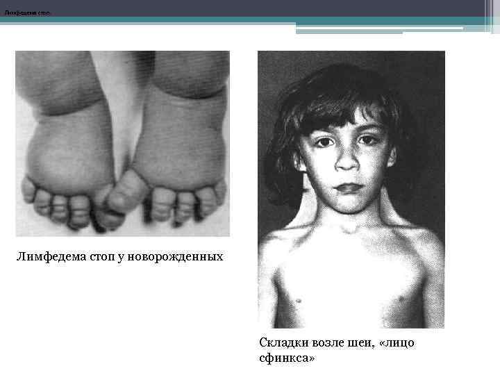 Лимфедема стоп. Лимфедема стоп у новорожденных Складки возле шеи, «лицо сфинкса» 
