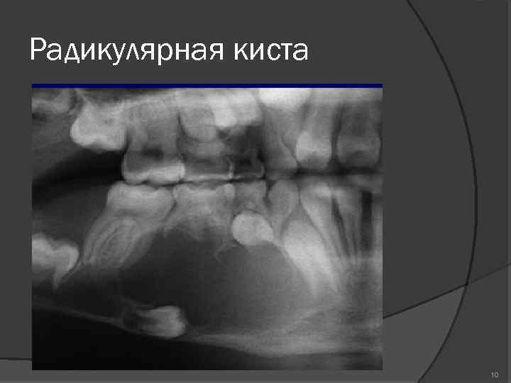 Для рентгенологической картины радикулярной кисты характерны изменения костной ткани