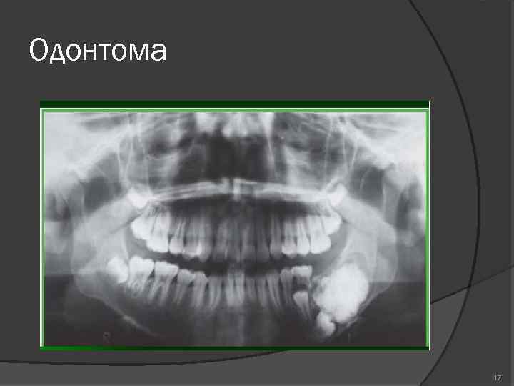 Клиническая картина сложной и составной одонтомы характеризуется