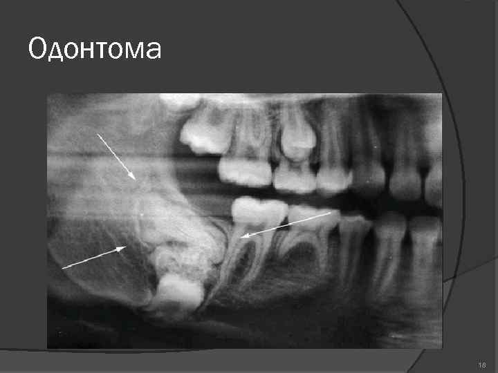 Одонтома 18 