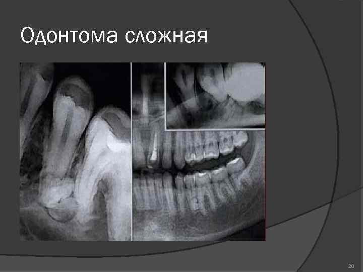 Одонтома сложная 20 