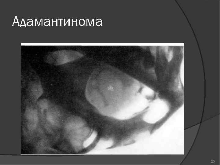 Адамантинома 26 