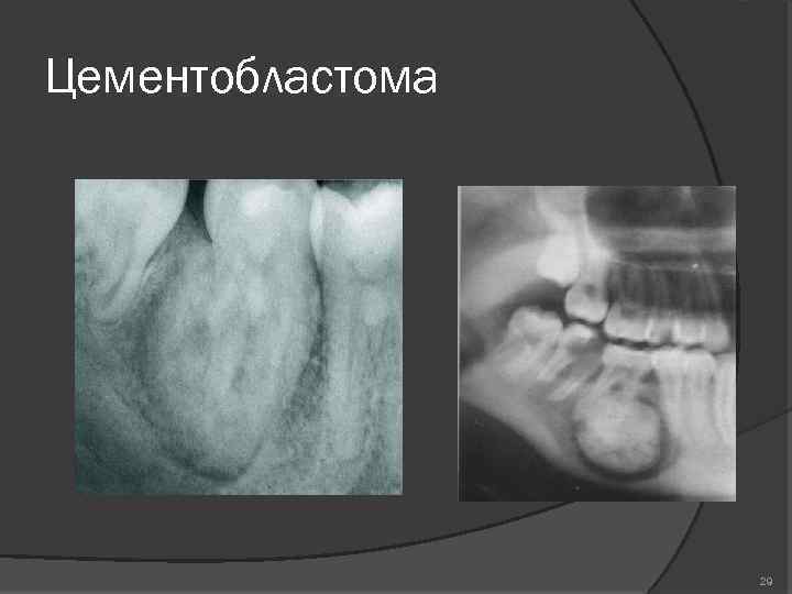 Цементобластома 29 