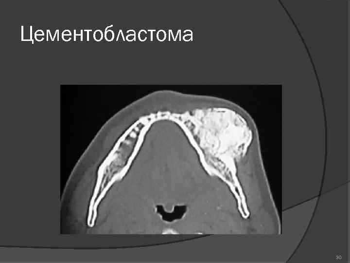Цементобластома 30 