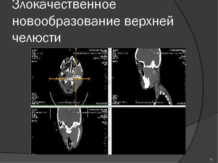 Злокачественное новообразование верхней челюсти 36 