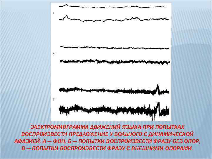 ЭЛЕКТРОМИОГРАММА ДВИЖЕНИЙ ЯЗЫКА ПРИ ПОПЫТКАХ ВОСПРОИЗВЕСТИ ПРЕДЛОЖЕНИЕ У БОЛЬНОГО С ДИНАМИЧЕСКОЙ АФАЗИЕЙ: А —