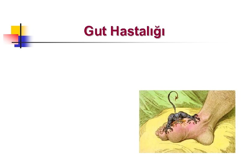 Gut Hastalığı 