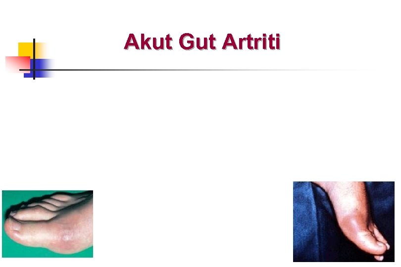 Akut Gut Artriti 