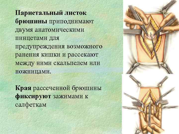 Париетальный листок брюшины приподнимают двумя анатомическими пинцетами для предупреждения возможного ранения кишки и рассекают