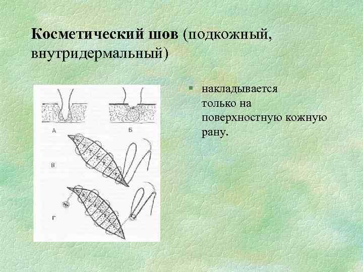 Косметический шов (подкожный, внутридермальный) § накладывается только на поверхностную кожную рану. 