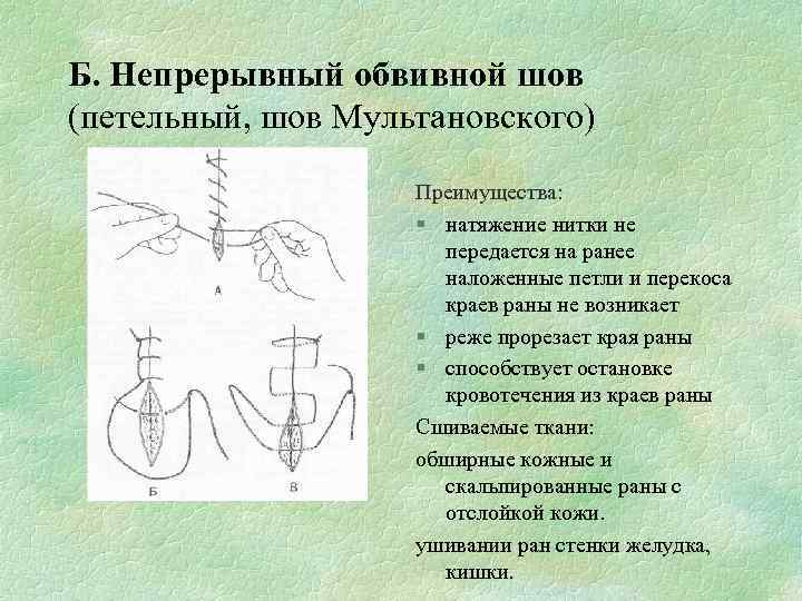 Б. Непрерывный обвивной шов (петельный, шов Мультановского) Преимущества: § натяжение нитки не передается на