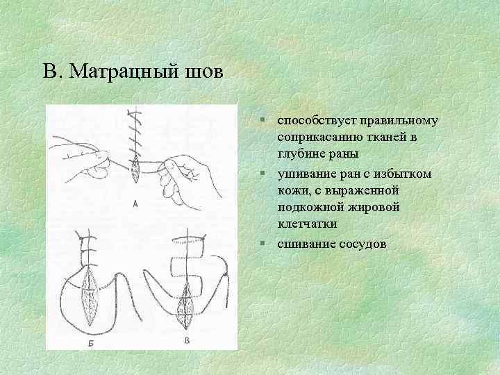 В. Матрацный шов § способствует правильному соприкасанию тканей в глубине раны § ушивание ран