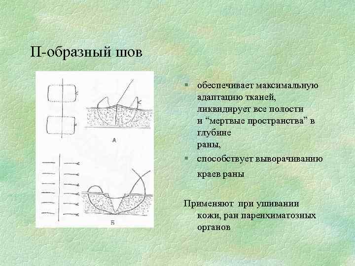 П-образный шов § обеспечивает максимальную адаптацию тканей, ликвидирует все полости и “мертвые пространства” в