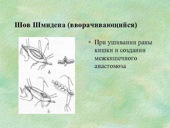 Шов Шмидена (вворачивающийся) § При ушивании раны кишки и создании межкишечного анастомоза 