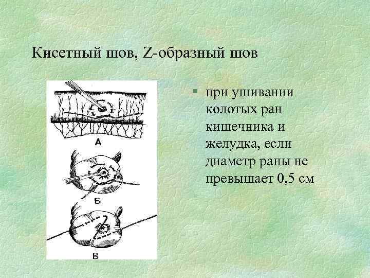 Кисетный шов, Z-образный шов § при ушивании колотых ран кишечника и желудка, если диаметр