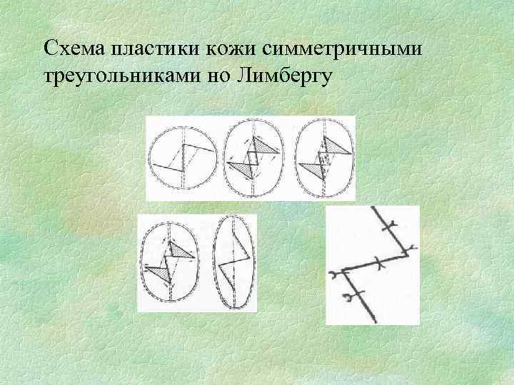 Схема пластики кожи симметричными треугольниками но Лимбергу 