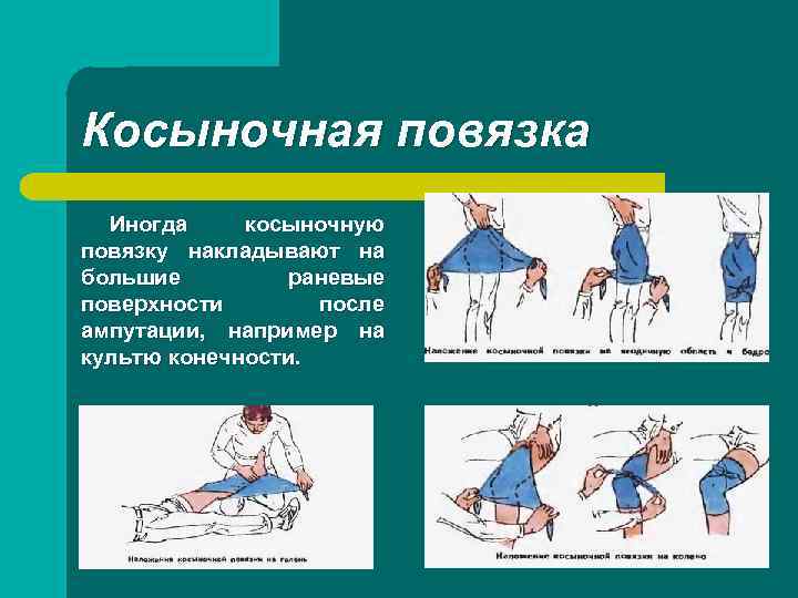 Косыночная повязка Иногда косыночную повязку накладывают на большие раневые поверхности после ампутации, например на
