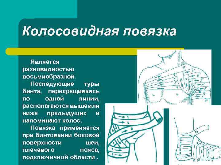Колосовидная повязка Является разновидностью восьмиобразной. Последующие туры бинта, перекрещиваясь по одной линии, располагаются выше