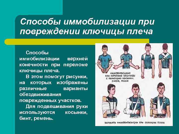 Способы иммобилизации при повреждении ключицы плеча Способы иммобилизации верхней конечности при переломе ключицы плеча.