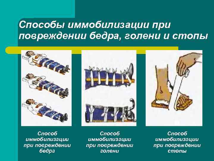Способы иммобилизации при повреждении бедра, голени и стопы Способ иммобилизации при повреждении бедра Способ