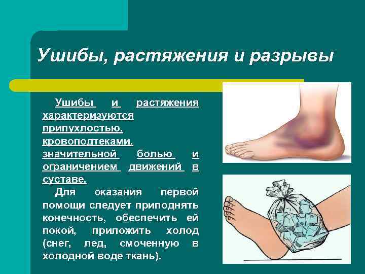 Ушибы, растяжения и разрывы Ушибы и растяжения характеризуются припухлостью, кровоподтеками, значительной болью и ограничением
