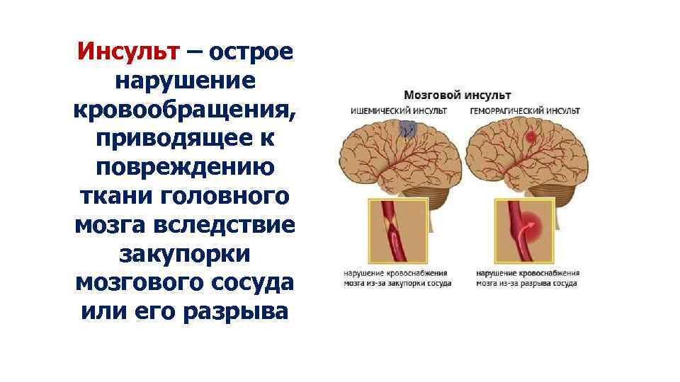 Инсульт – острое нарушение кровообращения, приводящее к повреждению ткани головного мозга вследствие закупорки мозгового