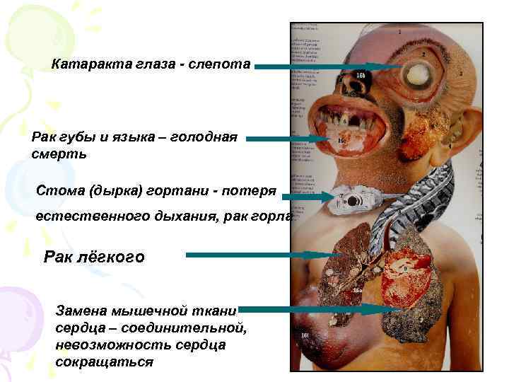 Катаракта глаза слепота Рак губы и языка – голодная смерть Стома (дырка) гортани потеря