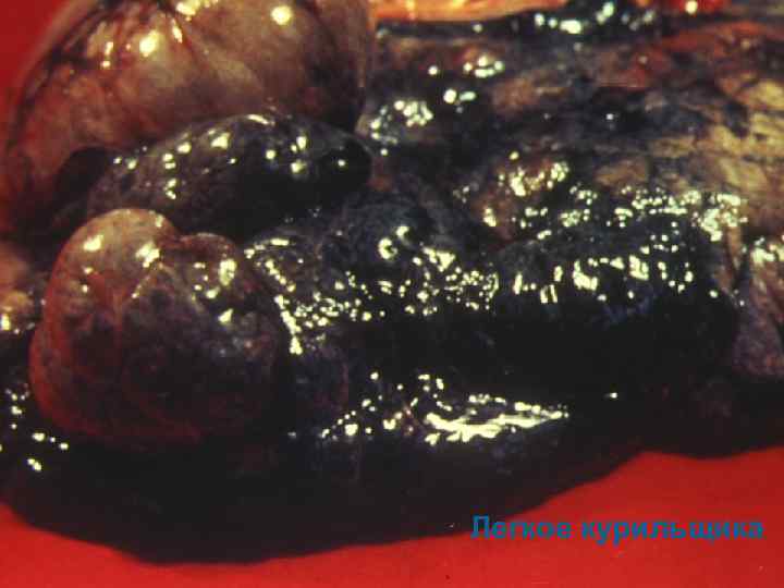 Легкое курильщика 