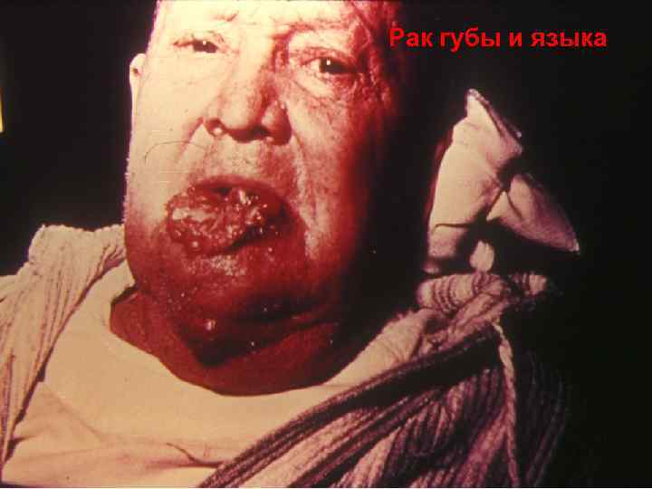 Рак губы и языка 