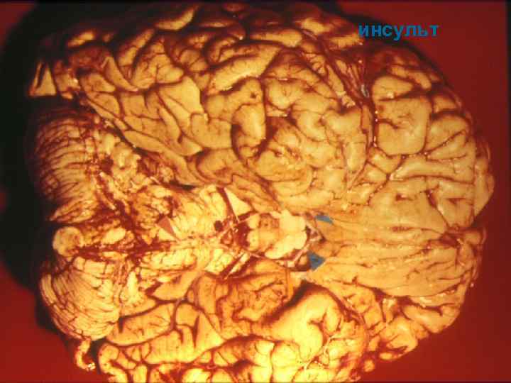 инсульт 