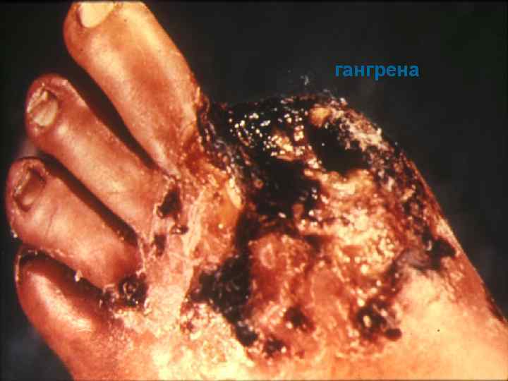 гангрена 